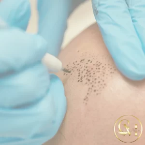 Hair micropigmentation
