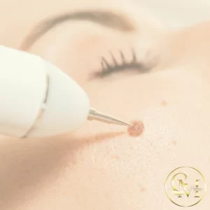 Removal of warts