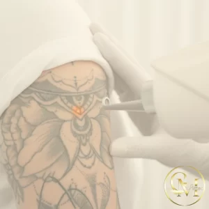 Tattoo removal
